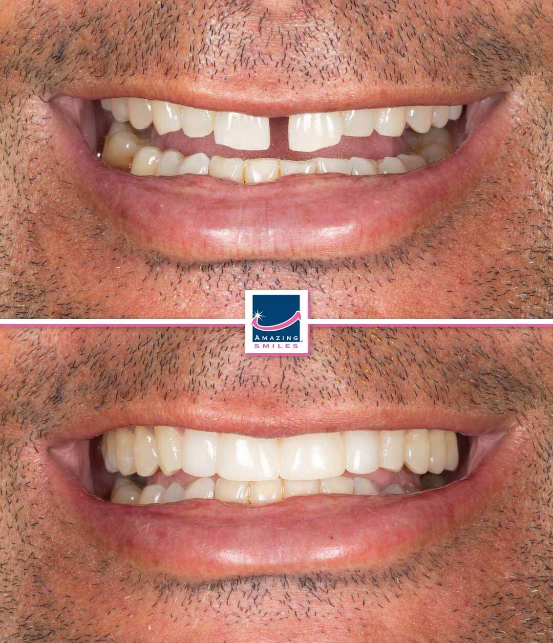 Dentist Jimboomba - Amazing Smiles Dental veneers jimboomba cosmetic dentist