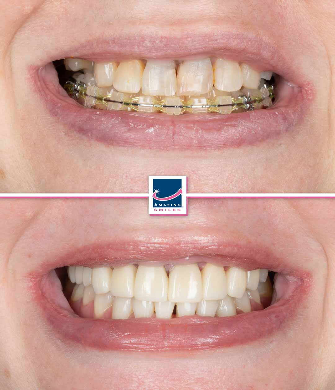 Dentist Bray Park - Amazing Smiles Dentist near me for orthodontics bray park