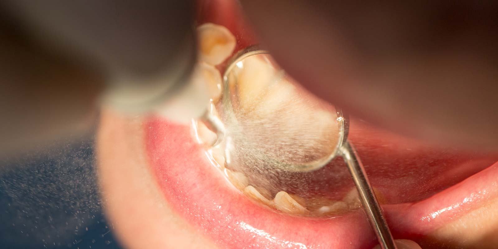 Dental Check-Up And Clean Dental check-up and clean