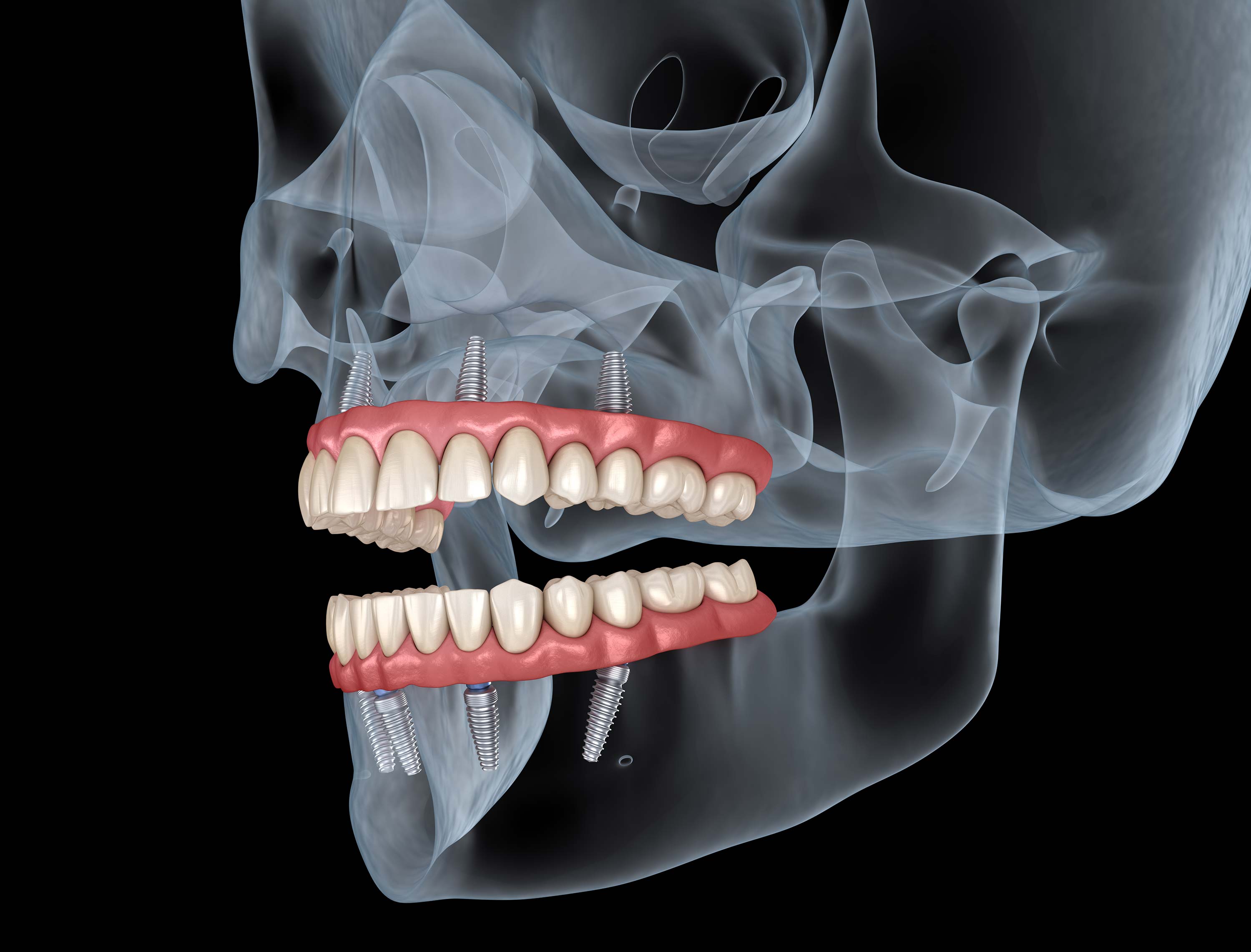 All on 4 implant dentist
